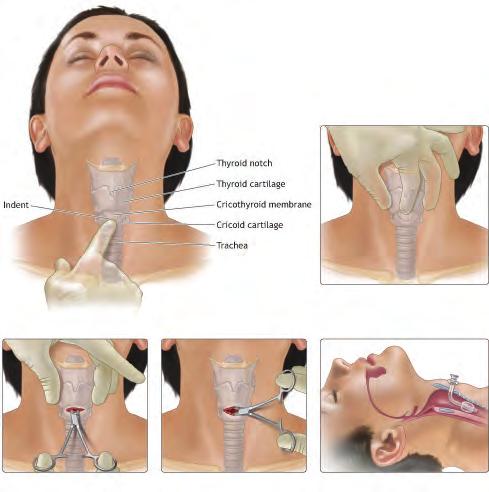 MANAGEMENT OF OXYGENATION 37 A B C D n FIGURE 2-16 Surgical Cricothyroidotomy. A. Palpate the thyroid notch, cricothyroid interval, and sternal notch for orientation. B. Make a skin incision over the cricothyroid membrane and carefully incise the membrane transversely.