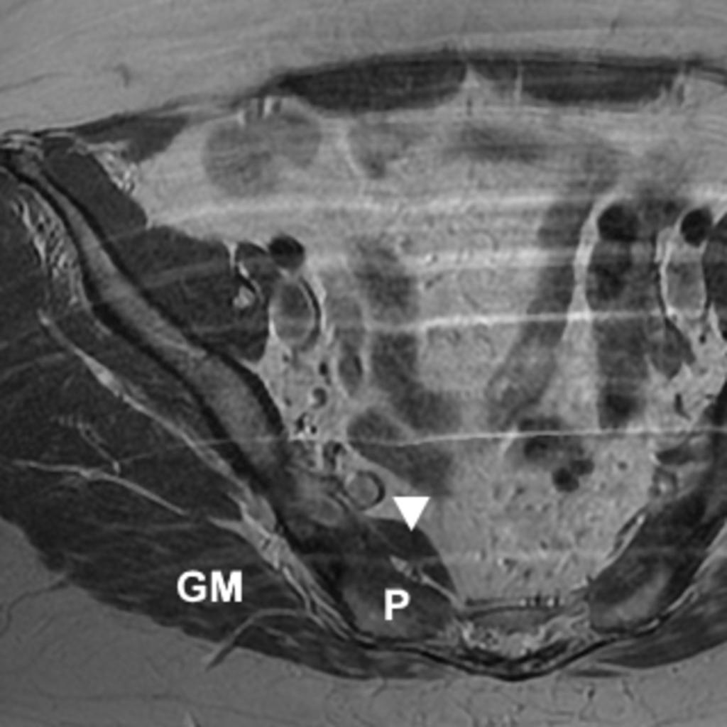 Fig. 10: Right intra-pelvic piriformis muscle slip emerging from the anterior sacrum on axial PD imaging (intra-pelvic muscle slip (white arrowhead),