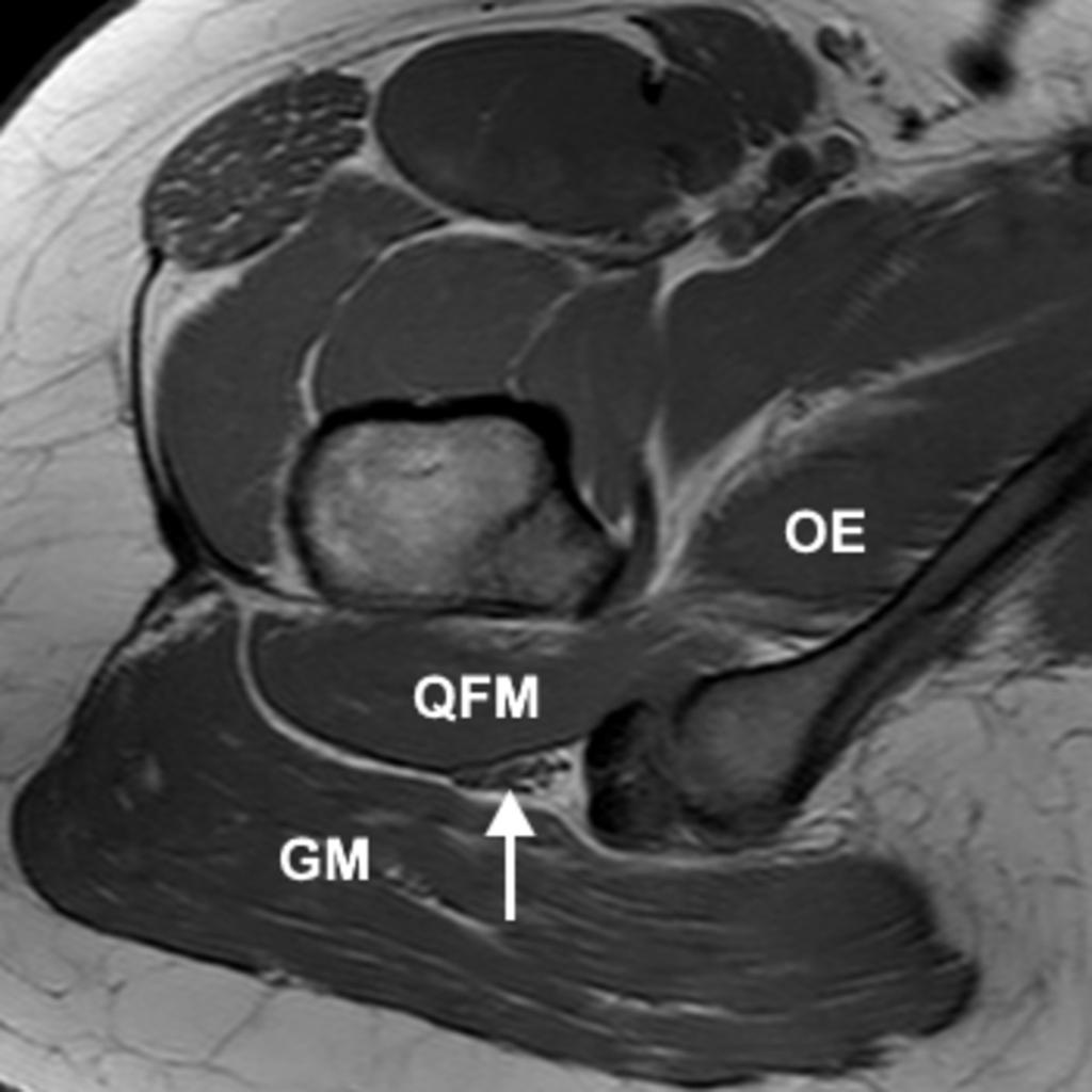Fig. 11: Left piriformis hypertrophy on axial PD images - case 1; case 2 (sciatic nerve (arrow), OI: obturator internus, P: piriformis, GM: gluteus maximus).