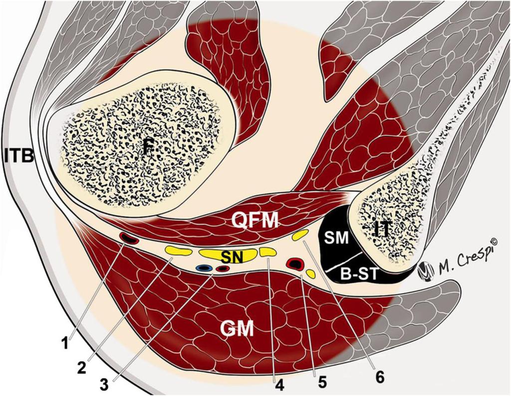 Fig. 2: Neurovascular structures of the SGW (ITB: iliotibial band, F: femur, QFM: quadratus femoris, SN: sciatic nerve, GM: gluteus maximus, SM: semimembranosus tendon, B-ST: conjoint tendon of