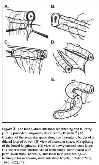 The longitudinal intestinal lengthening and tailoring