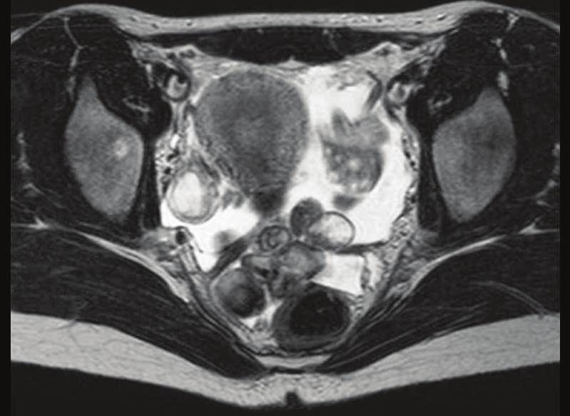 2 Case Reports in Pathology Figure 1: T2 weighted magnetic resonance imaging showing a multicystic mass (circle) and normal ovaries (arrows).