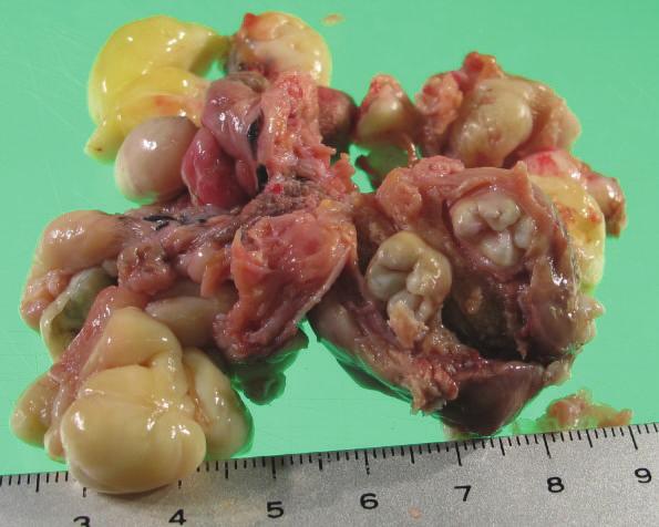 Case Reports in Pathology 3 Figure 3: Resected tumor (7.0 6.5 2.5 cm) and cut surfaces.