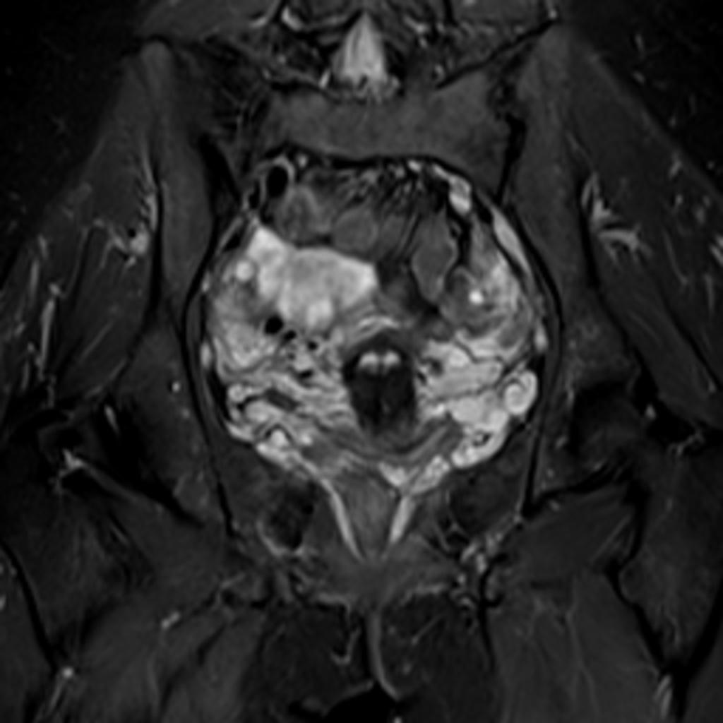 Fig. 5: MRI Pelvis.