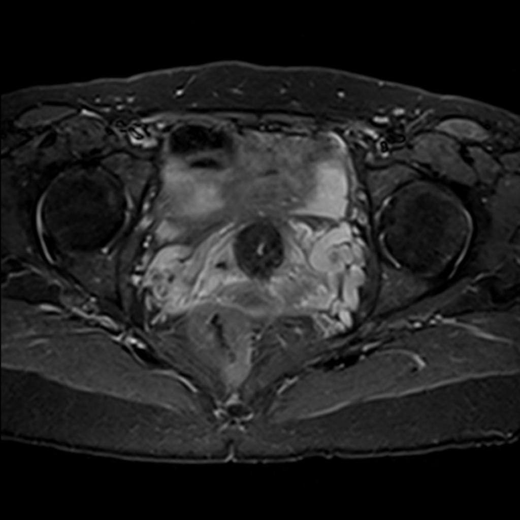 Fig. 6: MRI Pelvis.