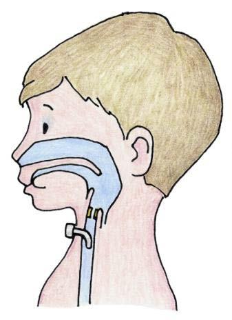 A Tracheostomy Tube A trache o tomy is a surgical procedure where the trache os tomy (the opening or stoma where the tube goes in) is placed The opening is