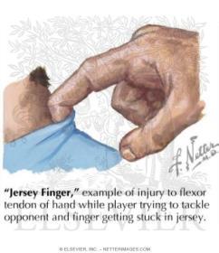 Finger Jersey Finger Avulsion of distal slip of extensor tendon Rapid forced flexion of distal phalanx Dec.