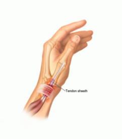 DeQuervain s Tenosynovitis Most common overuse injury of hand Common activities of forceful grip + UD (tennis serve) Pain dorsal/radial wrist along 1 st dorsal compartment w/rom (+) Finkelstein s