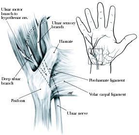 treatments for reducing inflammation NSAIDS Thumb Spica Surgical Release Guyon s Canal Entrapment