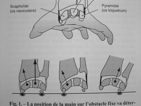 Lunotriquetral injuries Dinamic Lunotriquetral ligament Extension trauma and radial devation