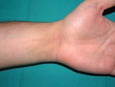 Swelling Wrist injuries