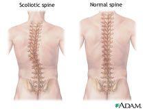 Scoliosis Scoliosis is defined as:! Sideways curvature of the spine!
