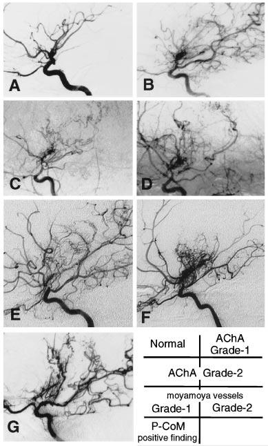 Morioka et al Dilation and Branching of AChA/P-CoM in Moyamoya Disease 91 Figure 1. Demonstrative cases in which moyamoya vessels were not considered a bleeding vessel. A and B, A 33-year-old female.