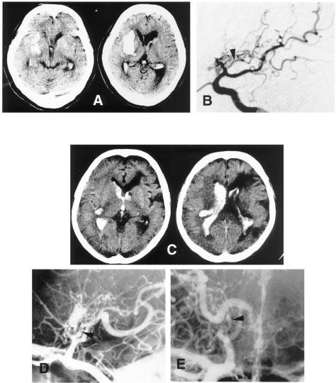 basal brain region in an effort to identify characteristic features of hemorrhagic moyamoya disease. Figure 2. Demonstrative angiograms.
