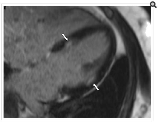 The ugly Asymptomatic myocardial fibrosis (scar) detected by MRI