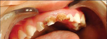 Early Childhood Caries (ECC) ECC = primary tooth decay in