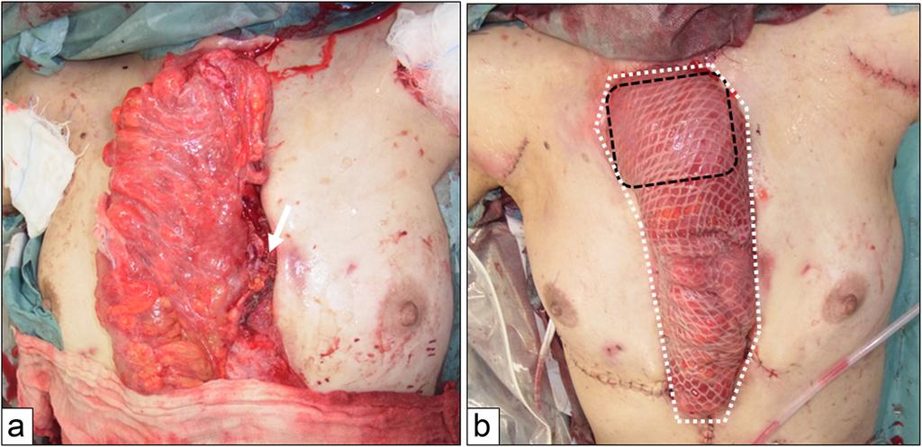 Sadanaga et al. Surgical Case Reports (2015) 1:22 Page 3 of 5 Figure 2 Schema of the reconstructed esophageal conduit. (a) The first reconstruction.