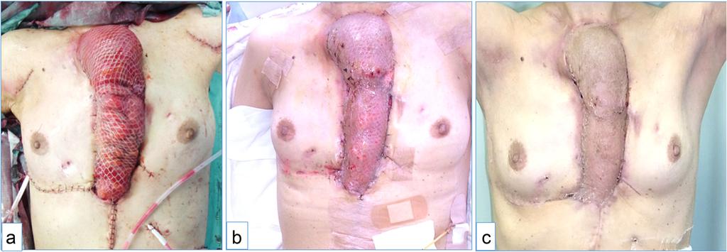 Sadanaga et al. Surgical Case Reports (2015) 1:22 Page 4 of 5 Figure 4 Esophageal conduit covered with a pectoralis major muscle flap and split thickness skin graft.