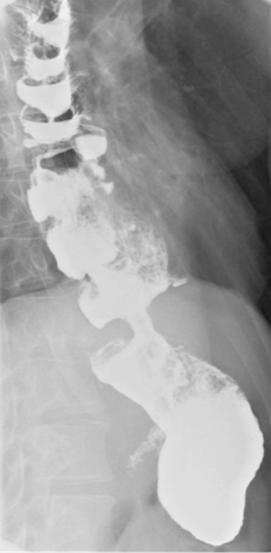Investigations were performed including a barium swallow study showed a siphon like appearance of the distal segment of the transposed colon (Figure 4), despite a significant increase in the transit