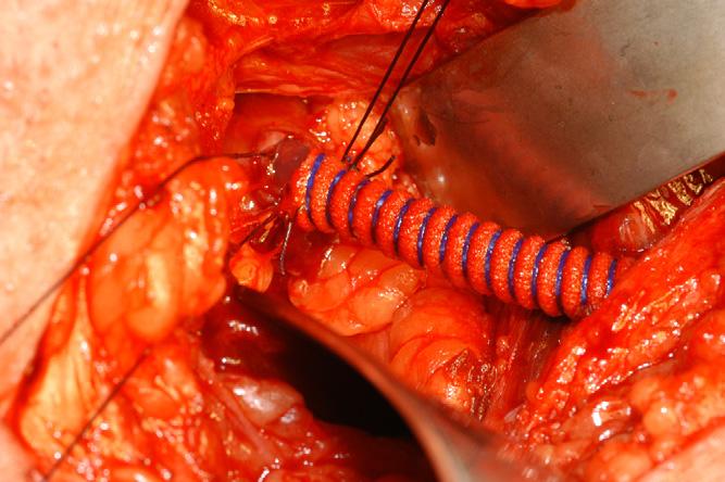 The catheter enables the operator to control bladder distension at exactly the right time in the procedure and can be used to check for a watertight seal around the lower end of the stent and to
