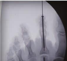 The screw is placed from the distal aspect of the digit crossing the DIPJ and PIPJ fusion site.