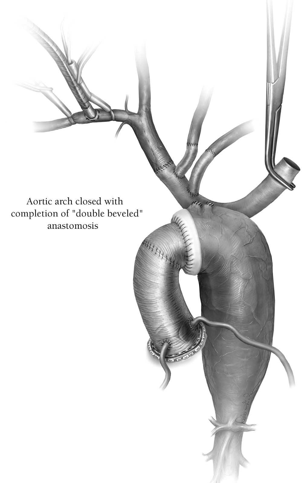 Aortic arch replacement/selective antegrade perfusion 33 Figure 10 A 2-0 polypropylene suture is used to