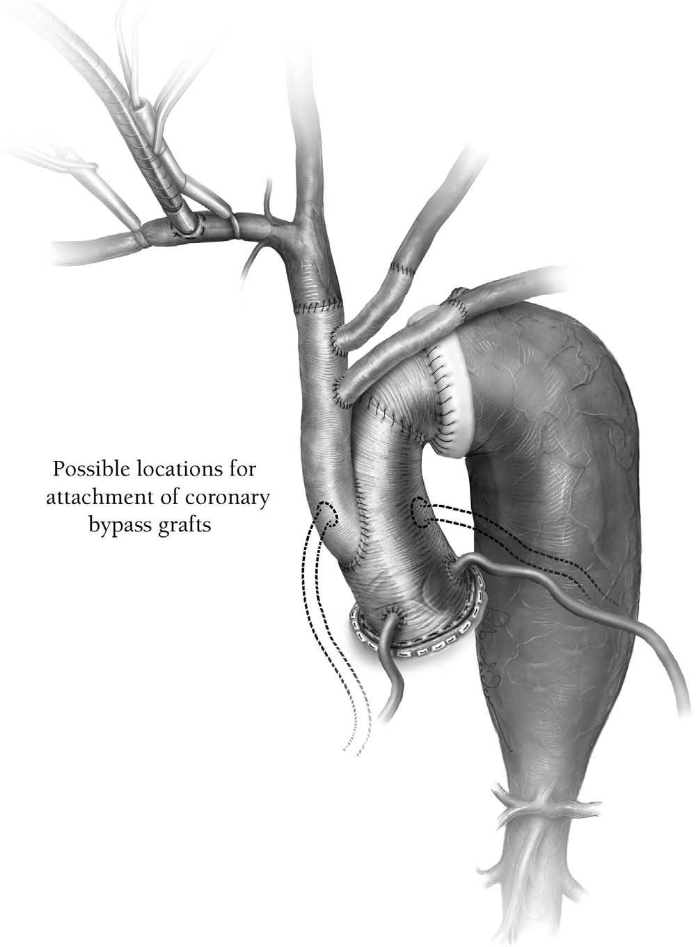 Aortic arch replacement/selective antegrade perfusion 35 Figure 12 For patients requiring coronary artery bypass, the grafts are left long.