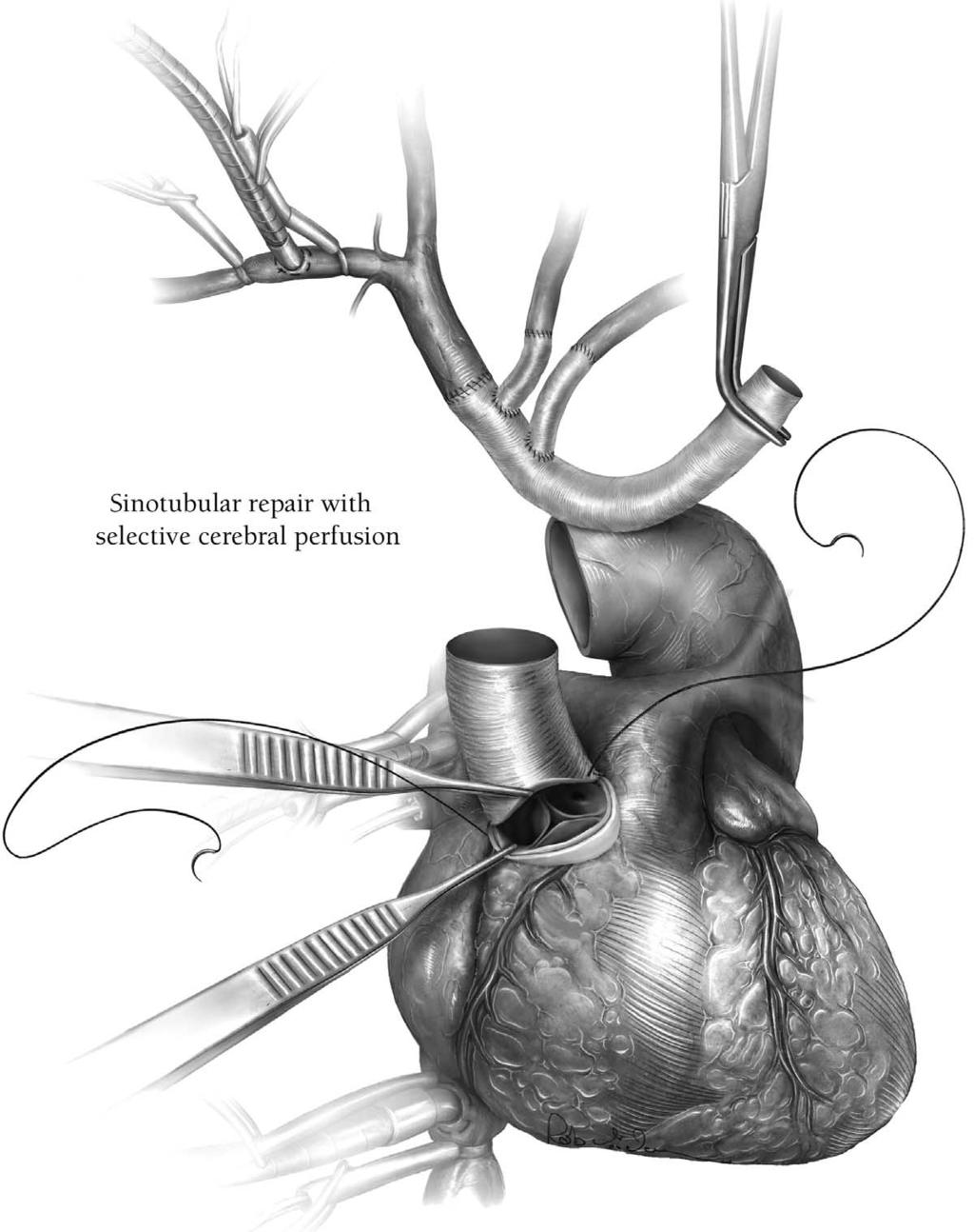 Aortic arch replacement/selective antegrade perfusion 37 Figure 14 Total aortic arch replacement for acute type A aortic dissection.