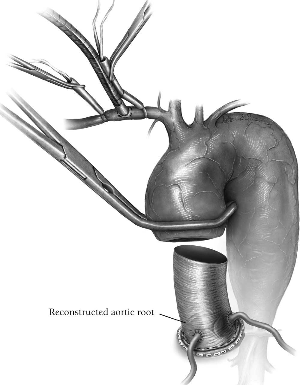 Aortic arch replacement/selective antegrade perfusion 27 Figure 4 In patients with significant aortic valve insufficiency or with the necessity of aortic root reconstruction, the ascending aorta is