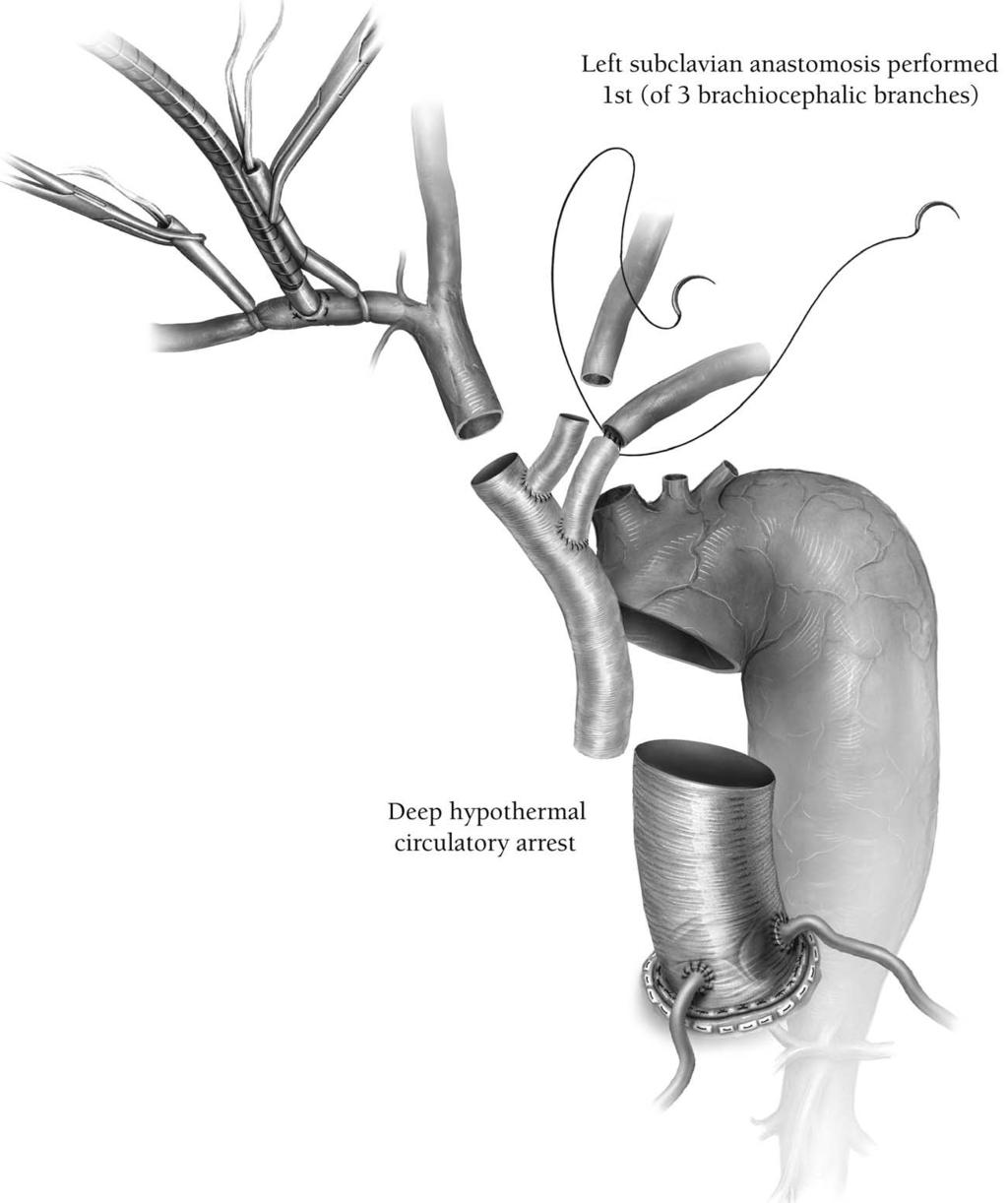 Aortic arch replacement/selective antegrade perfusion 29 Figure 6 During deep hypothermic circulatory arrest, the brachiocephalic vessels are transected just distal to their origins sharply with a