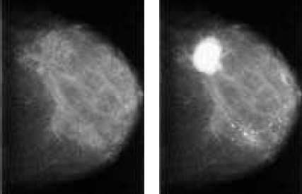 8 8 M(x) = J (a, b) (2) a=1 b=1 Figure 1. Typical mammogram; left: Normal Breast, right: Cancerous Breast This paper proposes a new algorithm addressed to perform prescreening of digital mammograms.