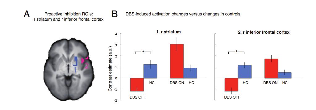 DBS modulates inhibitory control in OCD signal reaction time: F < 1) and accuracy of inhibition (F < 1), and the level of activation in the striatum (F < 1).