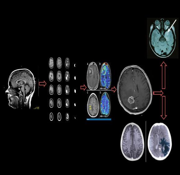 network method is proposed in order to classify the MR images into normal, benign and malignant brain tumour images noninvasively, thereby, prevent the intervention of invasive techniques such as