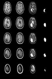 They concluded that PNN is a promising tool for brain tumour classification, based on its fast speed and its accuracy which ranges from 73 to 100% for spread values (smoothing factor) from 1 to 3.