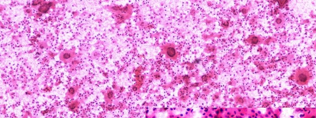 cytology of spinal juvenile xanthogranuloma nucleus, the differential diagnosis of Langerhans cell histiocytosis was ruled out and a diagnosis of Juvenile Xanthogranuloma was suggested.