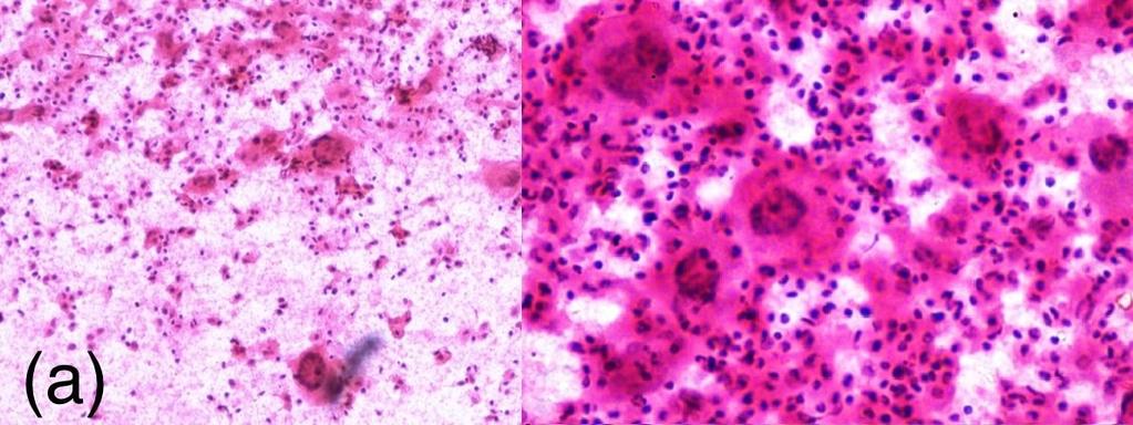 On microscopic examination of paraffin embedded sections, the tumor was composed of Touton giant cells and large number of foam cells (histiocytes), in a background of spindle cells, eosinophils,