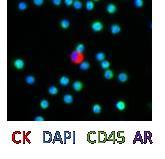 Instability Genomic from Insta Phenotype Phenotype Protein Biomarker Features Protein Biomarker Features CK cratio (protein expression) CK cratio (protein expression) AR cratio (protein expression)