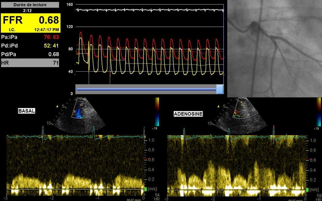 Non-invasive CFR by transthoracic Doppler