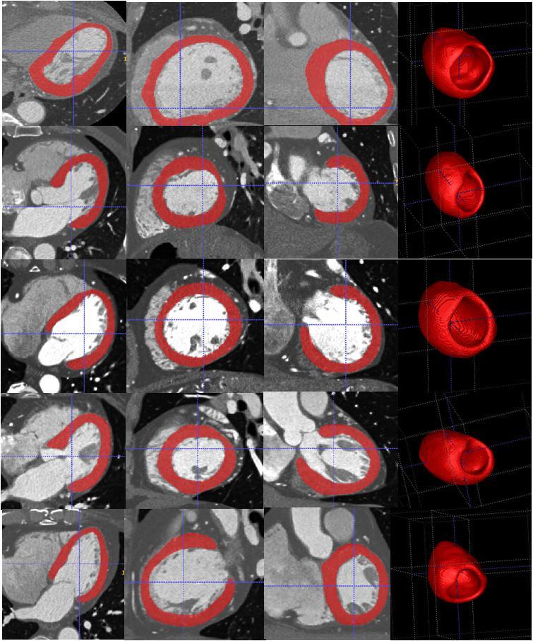FFR from CTA 1: Model REST coronary blood flow given left ventricular myocardial mass and assignment of myocardium to each coronary artery Allometric scaling laws can