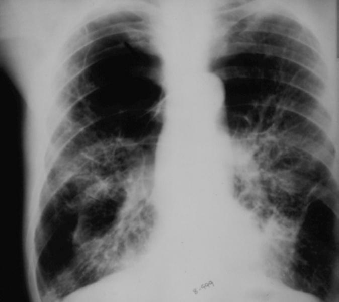 5 Figs. 3 and 4 http://rad.usuhs.mil/rad/handouts/feigin/abnlcxr/case008/top.htm Figs. 3 and 4, above, are two X-rays of another patient.