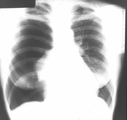 This constellation of findings barrel chest, flat diaphragms, and bullous lungs is consistent with COPD (chronic obstructive pulmonary disease) with emphysema. In Fig.