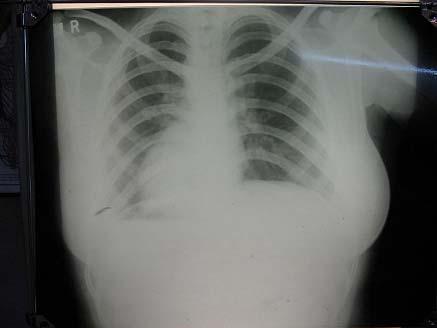 The cardiophrenic and left costophrenic angles are normal with a normally curved left hemidiaphragm.