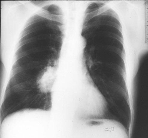 9 D. E. F. 2. Most chest radiographs are taken to. 3. You should be able to visualize the through the heart in a well-penetrated chest radiograph. 4.