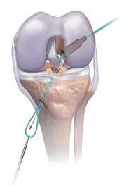 FEMORAL AND TIBIAL PREPARATION Femoral tunnel drilling A medial portal is created that gives access to the anatomic attachment of the ACL on the lateral wall of the femoral notch.
