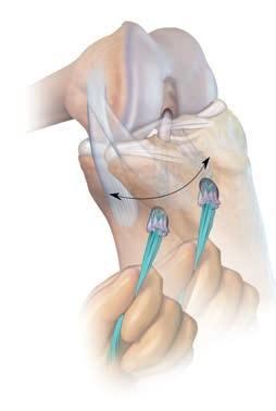 GRAFT INSERTION Pull suture tails through the tunnels Place about 3 to 4 of the implant s suture