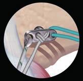 Pull the suture tails through the tibial and femoral tunnels and out through the thigh.