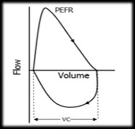 Normal spirometry results Flow-volume loop Peak Expiratory
