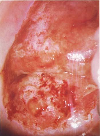 karcinoma( Burghart E.