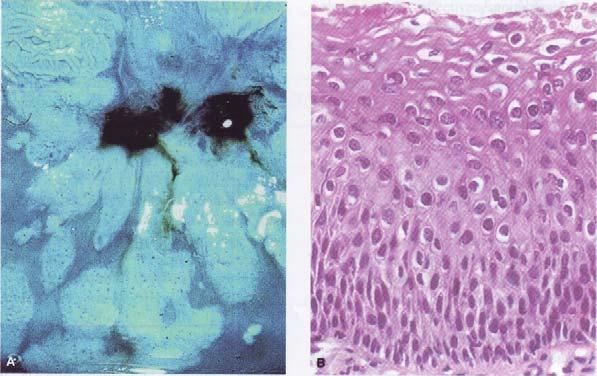 Slika 14,Histološka slika CIN 1, laka displazija (Eifel P.J. and Levenback C., Cancer of the Female Lower Genital Tract, 2001.