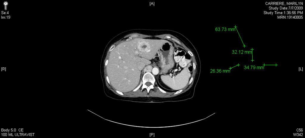 Metastatic NET:Liver-Directed Therapies Hepatic resection